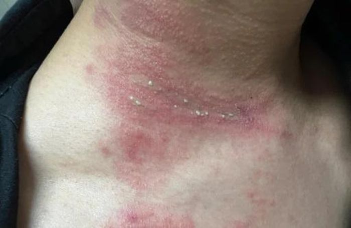  Khi bị chà xát hoặc nghiền trên da, kiến ba khoang giải phóng độc tố paederin, có thể gây bỏng rát, phồng rộp và nổi mụn nước sau 12-24 giờ. Ảnh: Medinet.