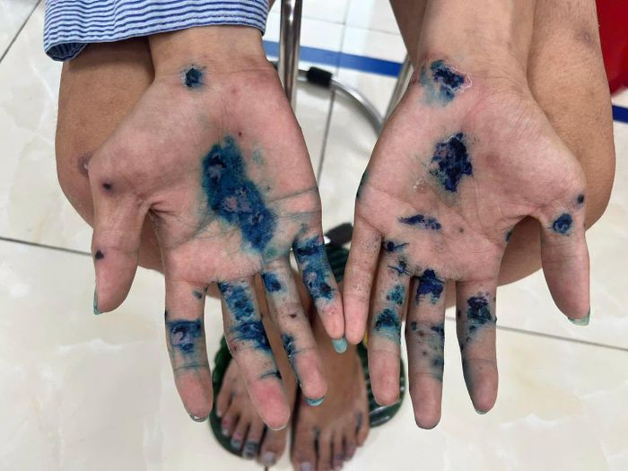 Chân tay nam thanh niên hóa mủ. Ảnh: BVCC