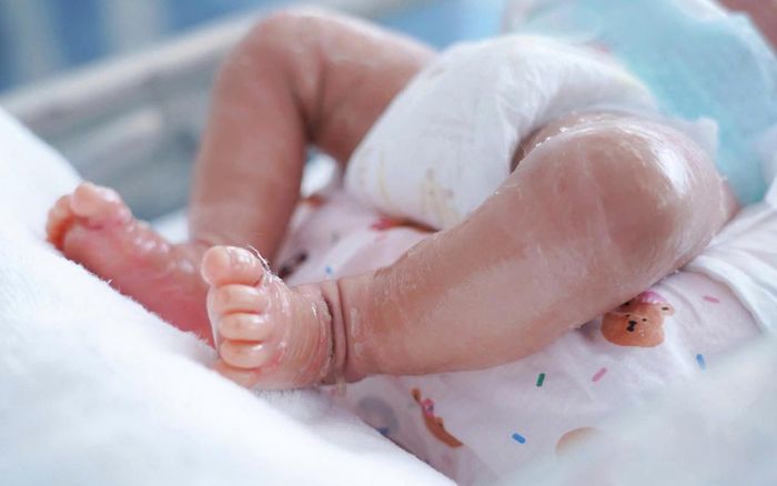 Ngay khi chào đời, bé đã bị suy hô hấp, da khô và căng bóng, bong vảy. Ảnh: BVCC.