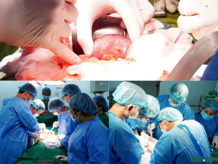 Khoảnh khắc quả thận của nữ nhân viên y tế được các bác sĩ nối mạch máu, ghép và trao sự sống cho 2 bệnh nhân đêm 24/9. Ảnh: Lê Bảo
