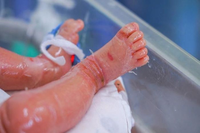 Ngay sau sinh bé trai đã bị suy hô hấp, da khô, nứt nẻ, căng bóng... Ảnh: BV cung cấp