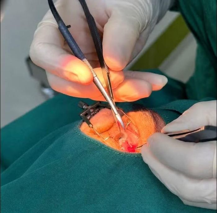 Phẫu thuật mộng thịt cho bệnh nhân - Ảnh BVCC