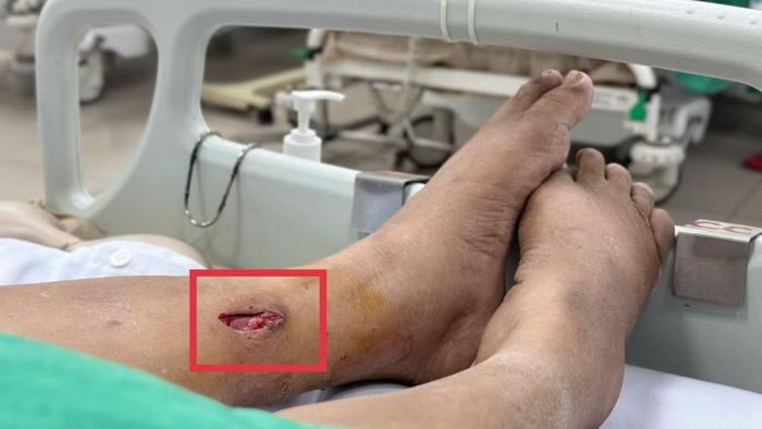 Các bác sĩ đã lấy mảnh tre ẩn sâu trong chân bệnh nhân - Ảnh BVCC