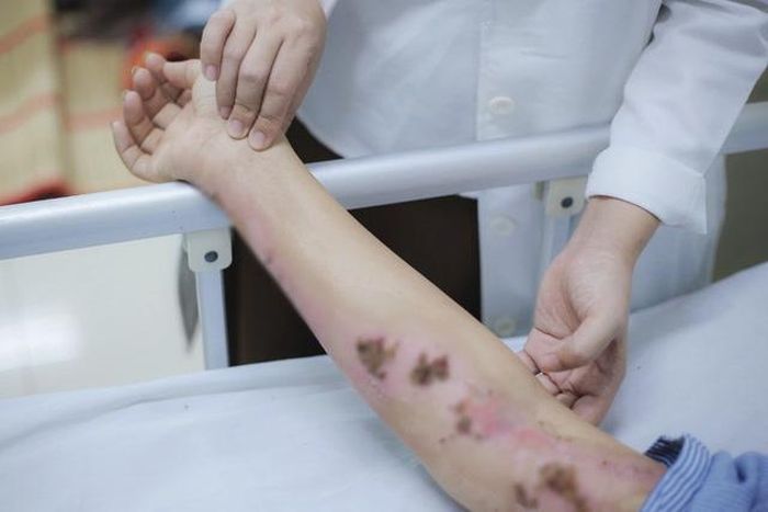 Người phụ nữ bị bỏng, cháy sém vùng cổ và nhiều vị trí trên cơ thể sau khi bị sét đánh (Ảnh: Bệnh viện cung cấp).