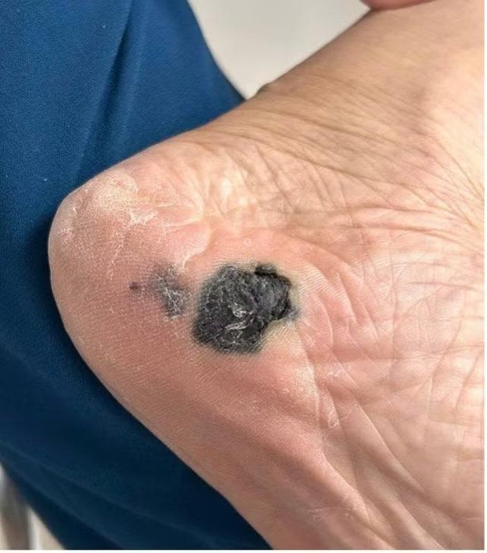 Những vết đen ở dưới chân được xác định là ung thư tế bào hắc tố.