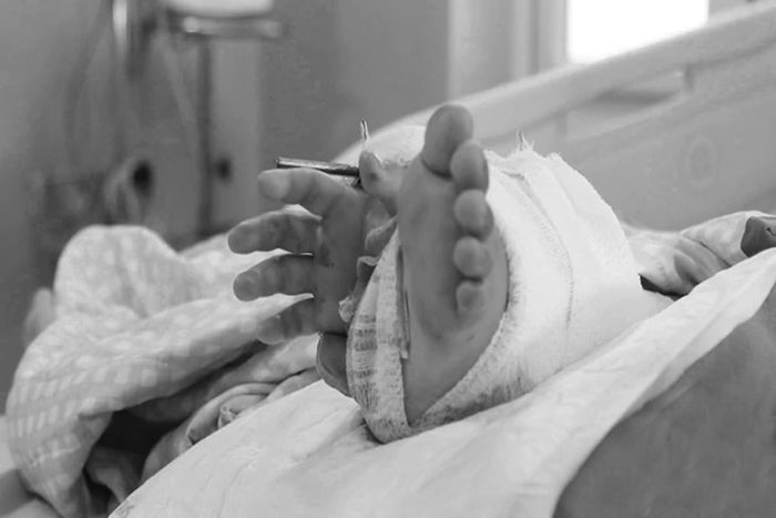 Bàn tay bị đứt lìa được ghép tạm vào cẳng chân để duy trì nguồn máu nuôi dưỡng, chờ thời điểm tái tạo.