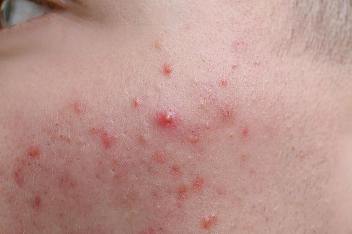 Trứng cá đỏ là bệnh mạn tính, có thể tái phát nhưng có thể kiểm soát bằng điều trị và chăm sóc phù hợp. Ảnh: Suckhoedoisong