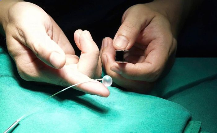 Quả bóng “đặc biệt” được sử dụng để gây bít khí quản thai nhi trong kỹ thuật FETO (hình ảnh được ghi lại khi các bác sĩ diễn tập trên mô hình).