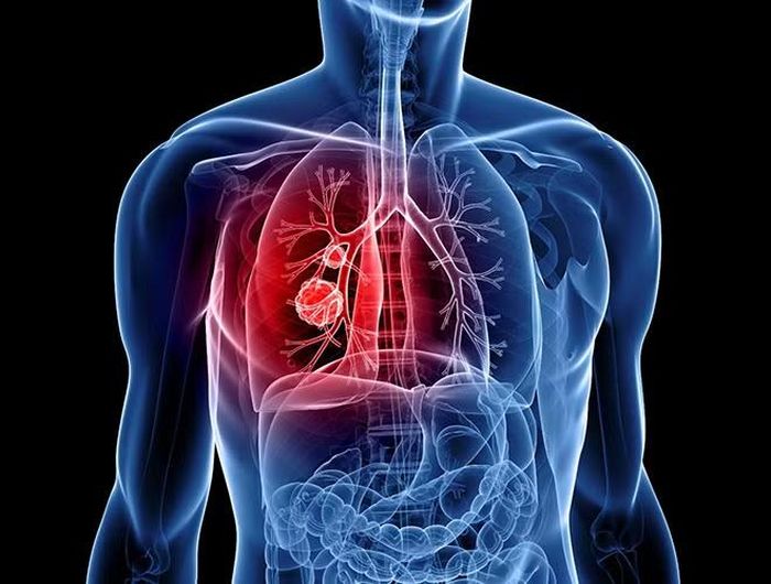 Một phần đáng kể tử vong do ung thư phổi có liên quan đến ô nhiễm không khí.