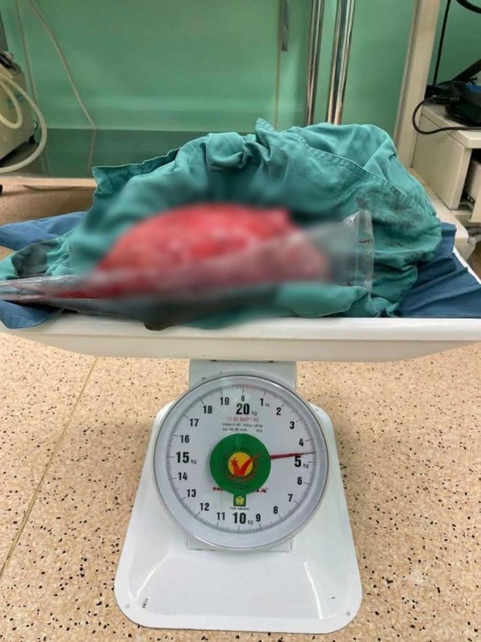 Khối u khổng lồ nặng tới 4,5 kg.
