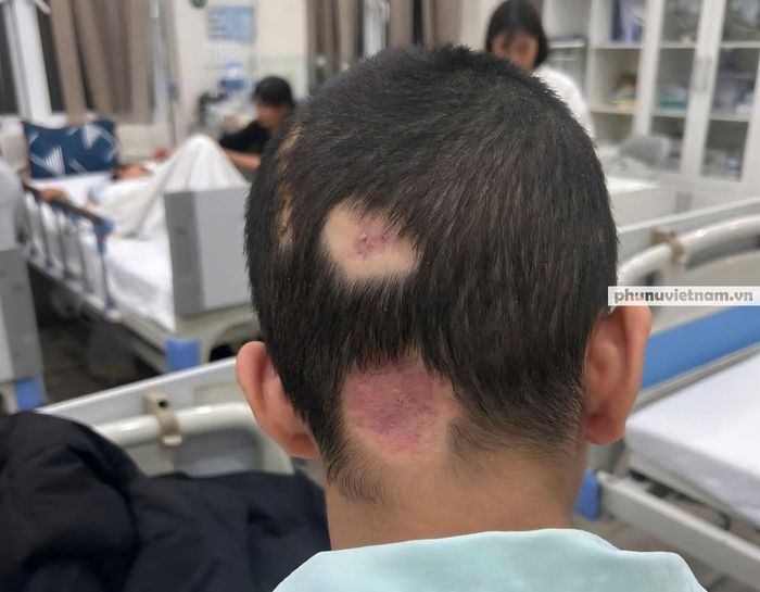 Chiều 16/1/2026, Q.A. đã được tháo chỉ vết khâu phẫu thuật nhưng nhiều vết thương khác vẫn còn hiện rõ. Phía sau gáy, hai vết lớn tách biệt, đều trụi tóc, trong đó có vết còn dấu hiệu tụ máu dưới da.