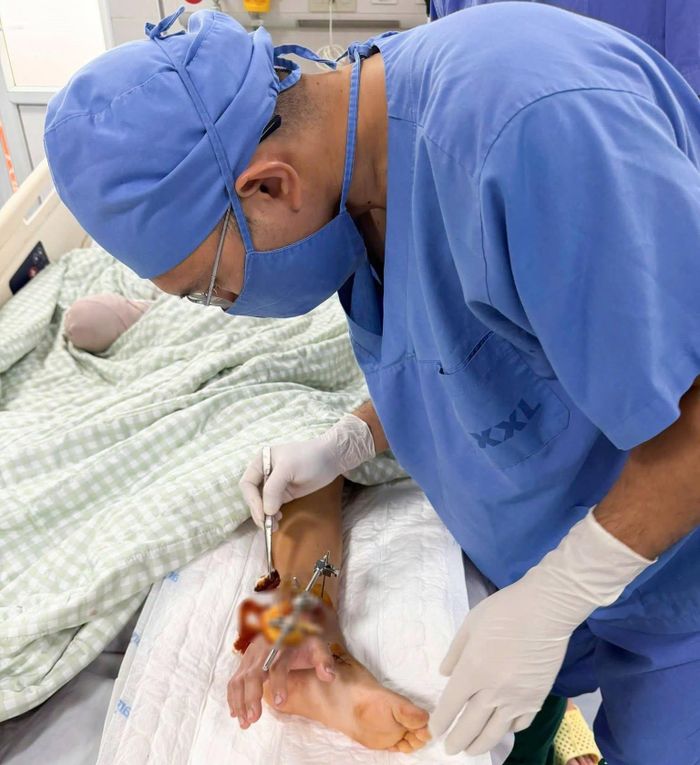 Bàn tay đứt lìa được nối tạm vào chân để duy trì tưới máu. Ảnh: BVCC