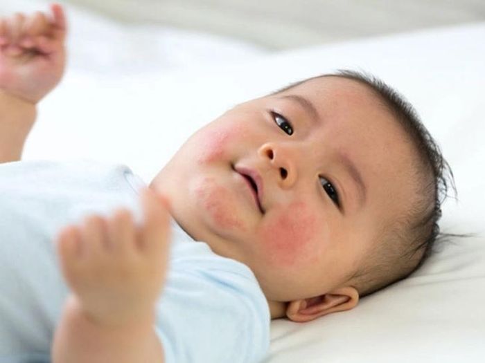 Bé nổi mề đay khi dị ứng sữa. Ảnh: GĐ