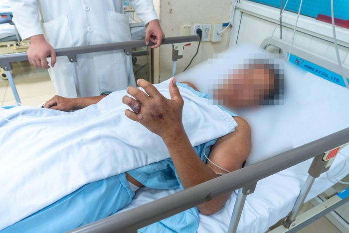  Bàn tay sưng phù của bệnh nhân bị rắn cắn. Ảnh: BVCC. 