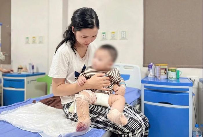 Trẻ bị bỏng nặng vì một thoáng sơ sẩy - Ảnh BVCC