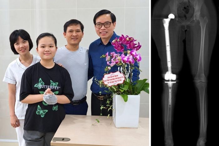 GS.TS.BS Trần Trung Dũng bên Linh Nhi cùng gia đình (trái) và ca đại phẫu thay toàn bộ xương đùi Titan in 3D năm 2021 (phải) giúp Linh Nhi giữ lại đôi chân. (Ảnh: GĐCC)