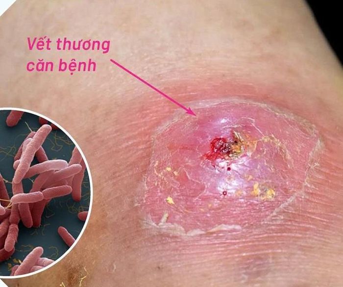 Vết thương ngoài da do Whitmore gây ra, có thể sưng đỏ, loét và chảy dịch. ẢNH: B.V