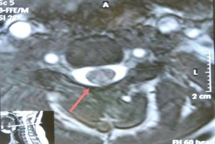  Hình ảnh tổn thương trên MRI cột sống cổ của bệnh nhân 24 tuổi. Ảnh: BVCC. 
