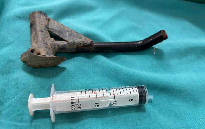 Chiếc chân chống xe máy được lấy ra khỏi cẳng chân người bệnh sau phẫu thuật.