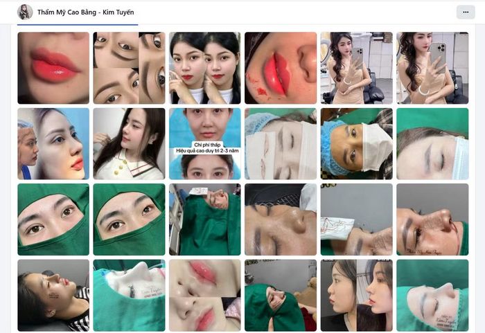 Trang mạng xã hội facebook Kim Tuyến đăng tải hàng loạt video, hình ảnh sử dụng thủ thuật y tế xâm lấn để làm đẹp.