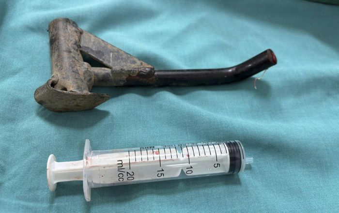Chiếc chân chống xe máy được các bác sĩ lấy ra khỏi cẳng chân người bệnh sau phẫu thuật.