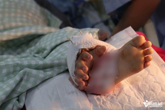 Do cẳng tay bị thương nặng, các bác sĩ phải nối tạm bàn tay xuống chân