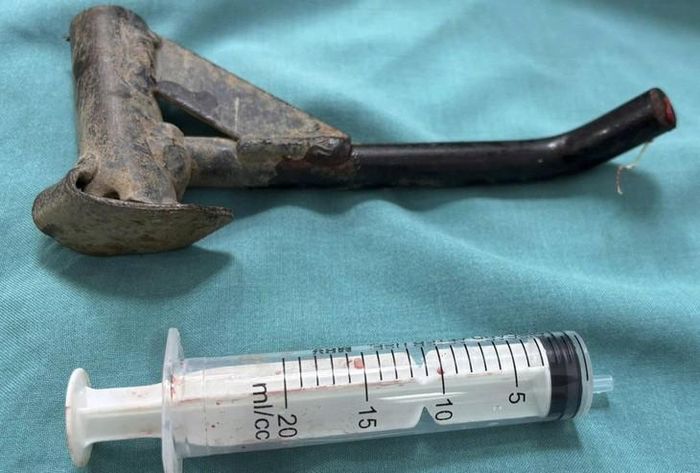 Hình ảnh chân trống xe máy sau khi được phẫu thuật lấy khỏi chân. Ảnh: BVCC.