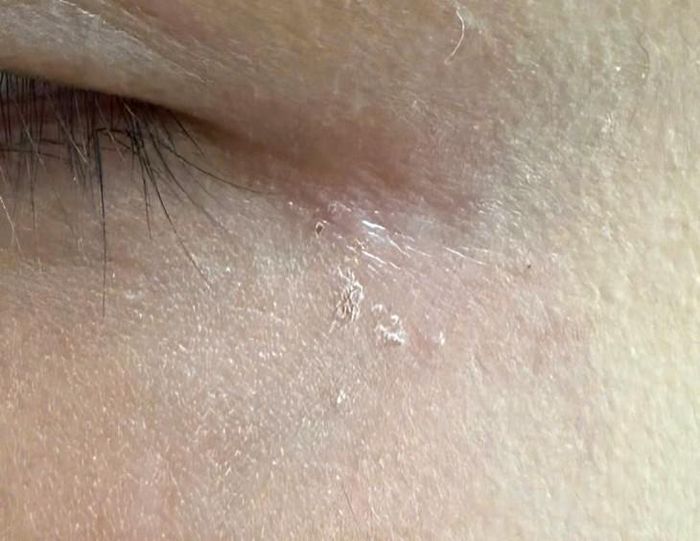 Hình ảnh PV bị bỏng khi không may để sản phẩm Tẩy đa năng SARO dính lên mặt. Ảnh: Quỳnh Mai.