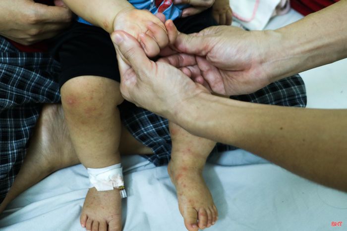 Trẻ mắc tay chân miệng thường xuất hiện các nốt ban, bóng nước ở lòng bàn tay, bàn chân, quanh miệng và có thể kèm sốt, biếng ăn.