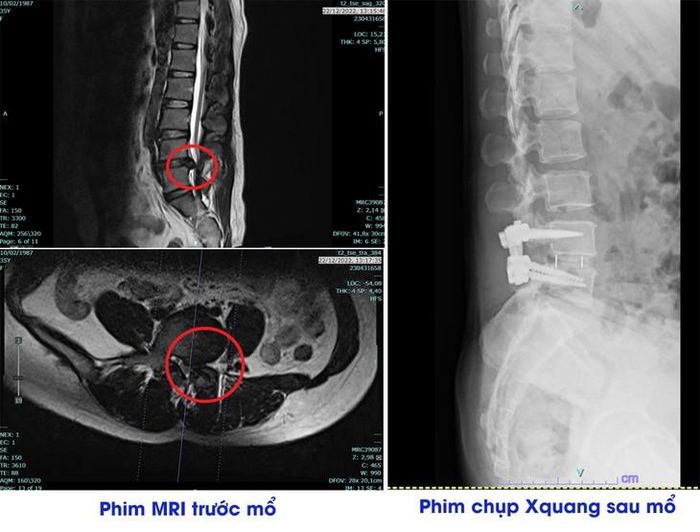 Quyết định phẫu thuật cần được đưa ra trên cơ sở kết hợp giữa triệu chứng – khám lâm sàng – hình ảnh học – đáp ứng điều trị, thay vì chỉ nhìn vào kết quả MRI. Ảnh BVĐK Phú Thọ