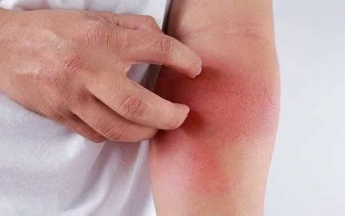 Dị ứng khi tiêm insulin - Ảnh minh họa BVCC