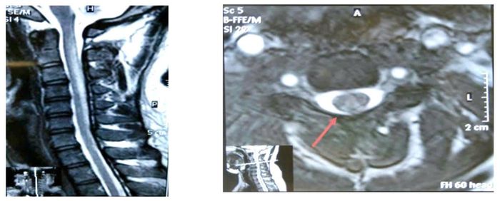 Hình ảnh tổn thương trên MRI cột sống cổ. Ảnh: BVCC