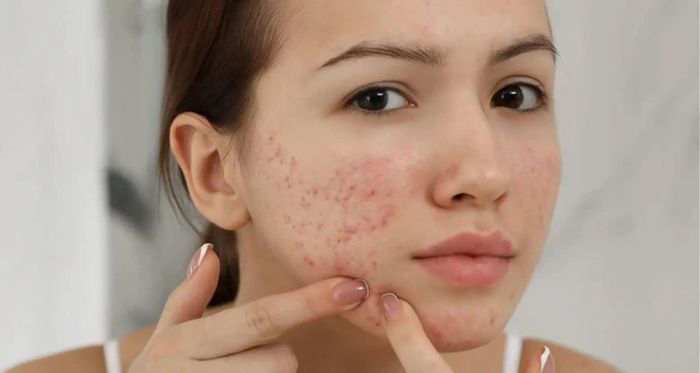 Một chu trình đơn giản, đều đặn và phù hợp sẽ giúp quá trình chăm sóc da sau mụn hiệu quả