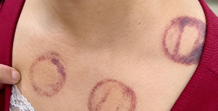 Nữ bệnh nhân từng đi giác hơi với mục đích “hút máu độc” để phòng đột quỵ. (Ảnh: BSCC)