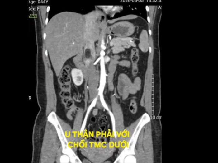 Hình ảnh chụp CT (cắt lớp vi tính) của bệnh nhân cho thấy u thận phải với chồi tĩnh mạch chủ dưới. Ảnh: BVCC