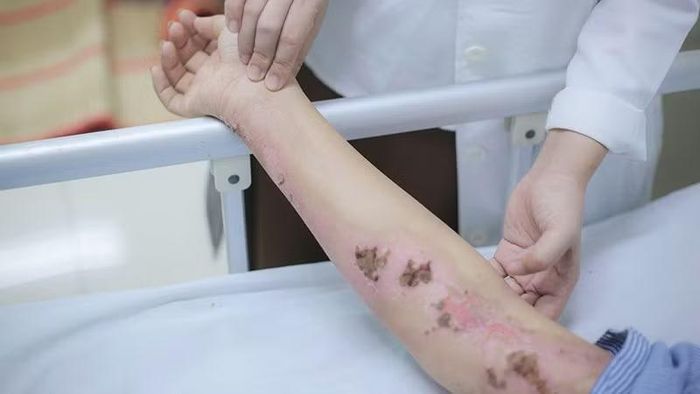 Vết thương cháy sém tay do sét đánh. (Ảnh: Bệnh viện cung cấp)