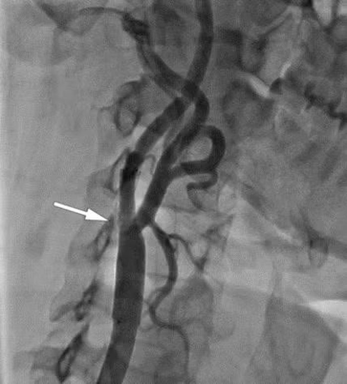 Trường hợp hẹp khít động mạch cảnh được phát hiện và đặt stent điều trị tại Viện Tim mạch, Bệnh viện Bạch Mai.