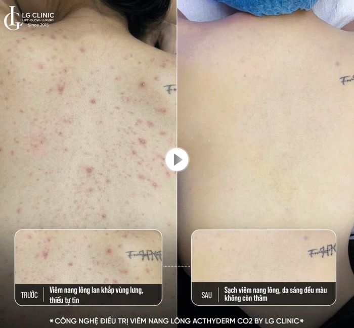 Điều trị mụn lưng, viêm nang lông bằng phác đồ Acthyderm – CO2 tại LG Clinic.