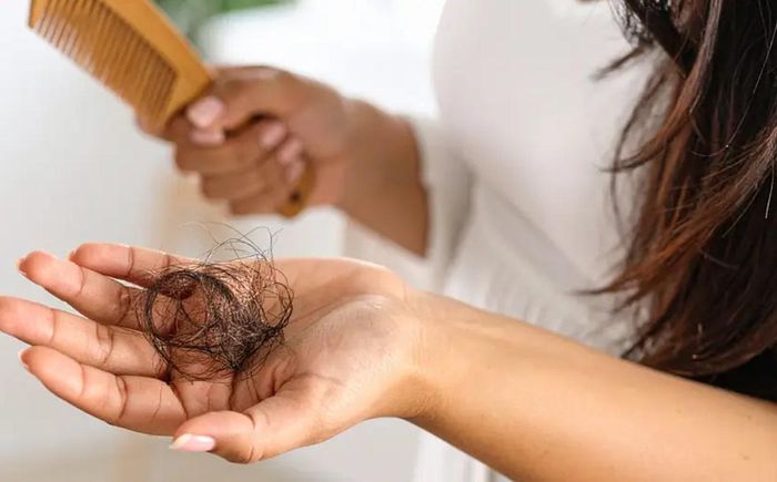 Viêm da tiết bã có thể góp phần làm tăng tình trạng rụng tóc ở một số người. Ảnh Minh Hiếu