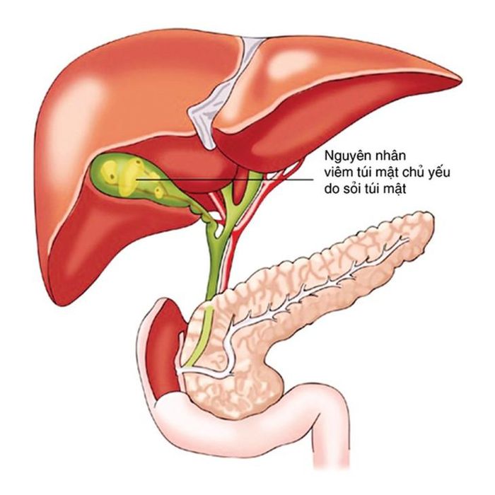 Sỏi túi mật là bệnh lý khá phổ biến, nhưng không phải ai có sỏi cũng có triệu chứng hoặc cần điều trị. Ảnh M.H