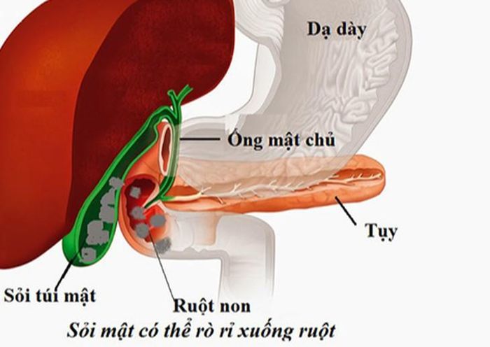 Quan trọng nhất, siêu âm phát hiện sỏi chỉ là bước đầu, quyết định có mổ hay không cần dựa trên toàn bộ bệnh cảnh lâm sàng và đánh giá chuyên khoa. Ảnh M.H