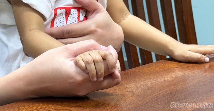 Sau đó, chị Hà đưa Bảo về học tại trường gần nhà để tiện chăm sóc. Hiện trẻ chỉ học buổi sáng. Do lo ngại thể trạng yếu, giáo viên đề nghị gia đình đón trẻ về ăn thay vì đăng ký bán trú. “Con vẫn ngoan, hòa nhập với các bạn và được cô giáo quan tâm”, chị Hà nói. Với người mẹ, điều đáng tiếc nhất không phải con phải chuyển trường, mà là một đứa trẻ mới 3 tuổi đã phải đối diện với ánh mắt dè chừng chỉ vì ngoại hình khác biệt.