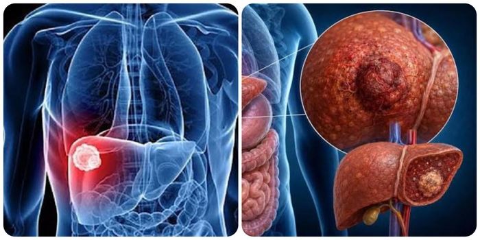 Nhận biết sớm các triệu chứng ung thư gan giúp việc điều trị dễ dàng hơn