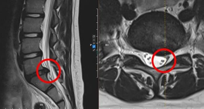 Vị trí khối thoát vị chèn ép thần kinh của Nam trên phim chụp MRI. Ảnh: BVCC
