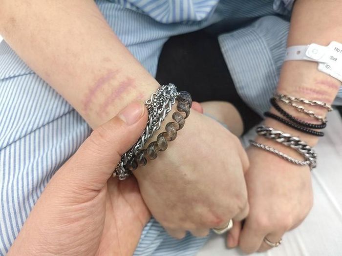 Một nữ sinh 15 tuổi với những vết thương chằng chịt tự rạch trên cánh tay. Ảnh Dương Liễu.