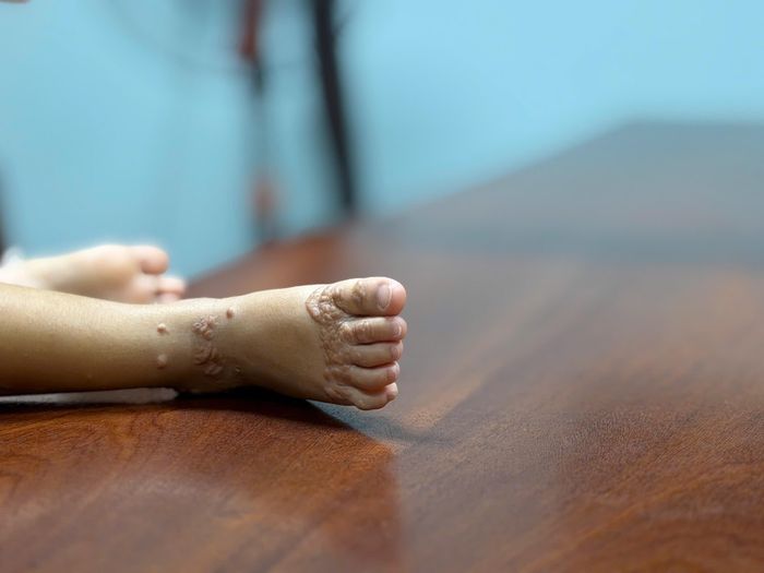 Làn da vàng như nghệ, u hạt vàng nổi rõ trên da khiến cậu bé 3 tuổi bị nhìn bằng ánh mắt e ngại. Ảnh: PA.