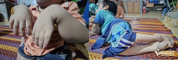 Chân tay các em teo nhỏ, mềm yếu, các khớp tay, khớp chân sưng lên. Ảnh: Hải Sâm