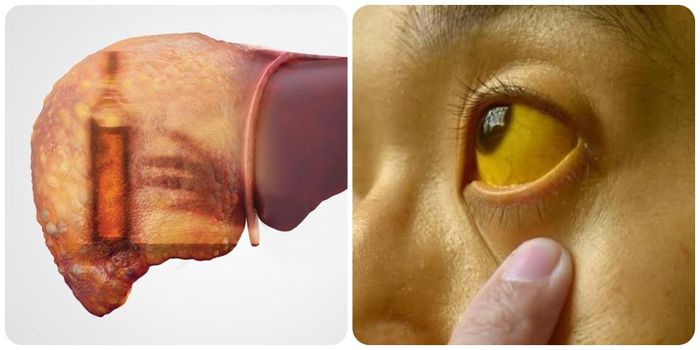 Ung thư gan giai đoạn cuối bệnh tiên lượng rất xấu, người bệnh biểu hiện các triệu chứng bệnh rầm rộ