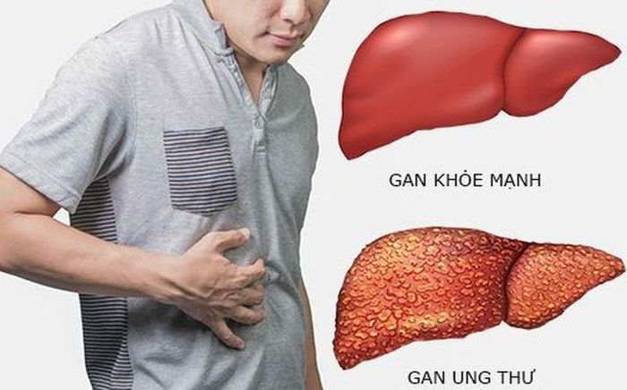 Hình ảnh ung thư gan và gan khỏe mạnh. Ảnh AI