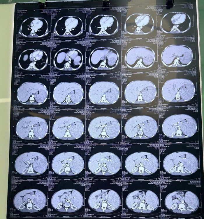  Cận cảnh phim chụp cắt lớp ổ bụng của bệnh nhân trước phẫu thuật. 